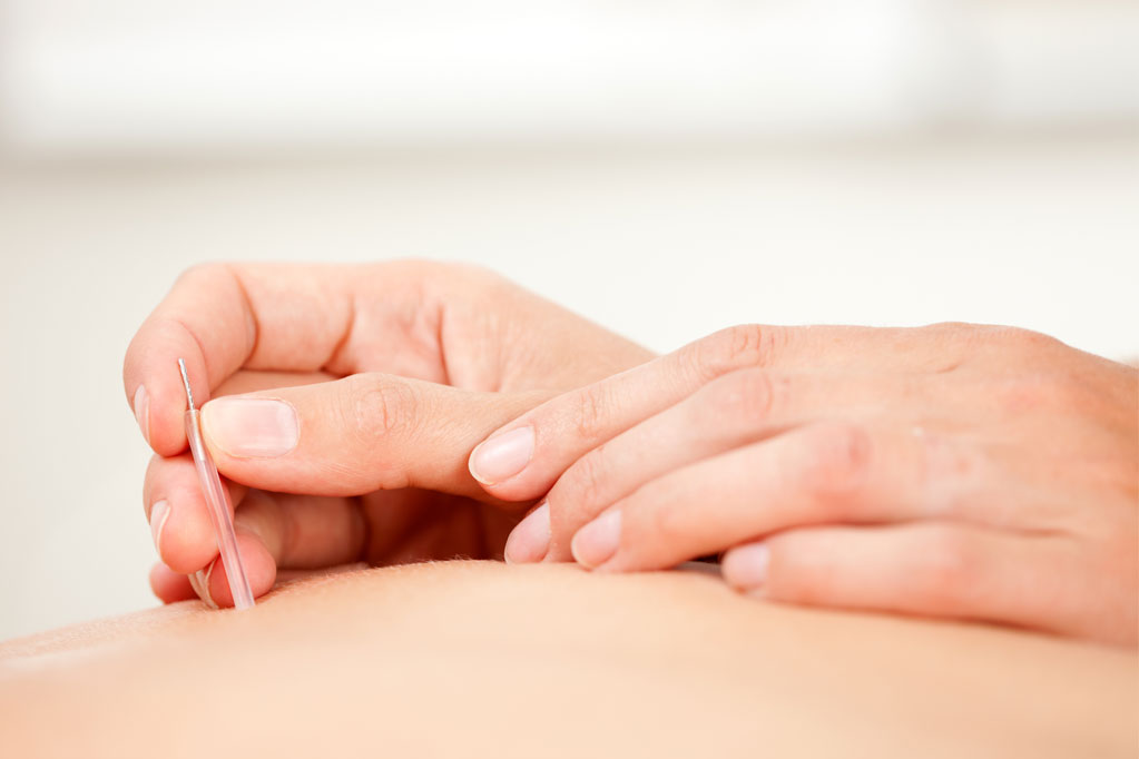 Acupuncture treatment 