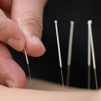 Edmonton Acupuncture Needles
