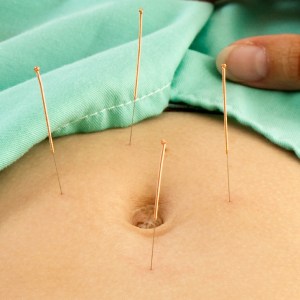 Needles used for acupuncture in Edmonton