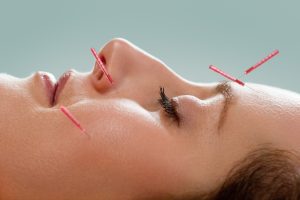 Woman getting cosmetic acupuncture