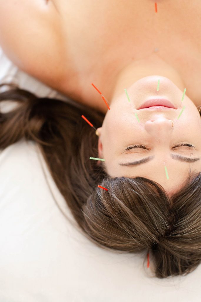 Photo of a female patient with acupuncture needles in her face as part of her acupuncture for stress management and mental health