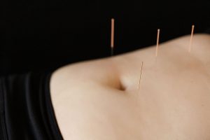 Four acupuncture needles on a female belly