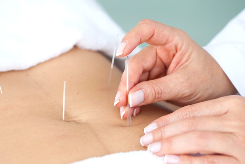 Fertility Acupuncture 