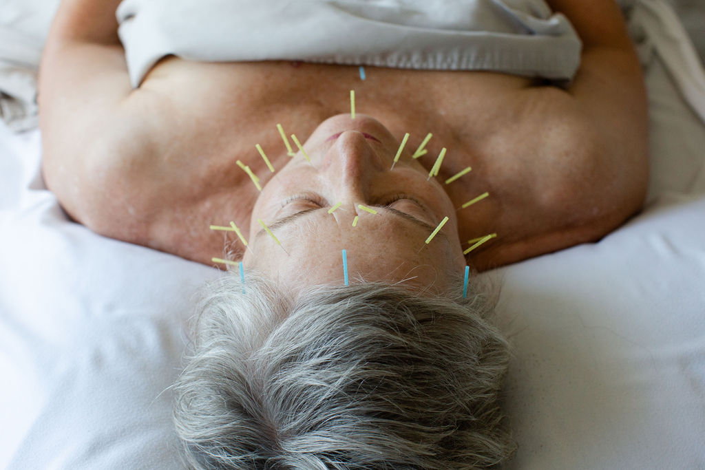 relieving stress through acupuncture in winter