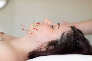 cosmetic acupuncture is one of the best Botox alternatives in Edmonton
