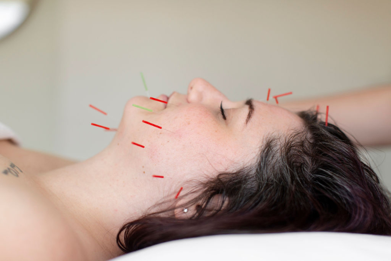 cosmetic acupuncture is one of the best Botox alternatives in Edmonton - post-acupuncture dos and don'ts