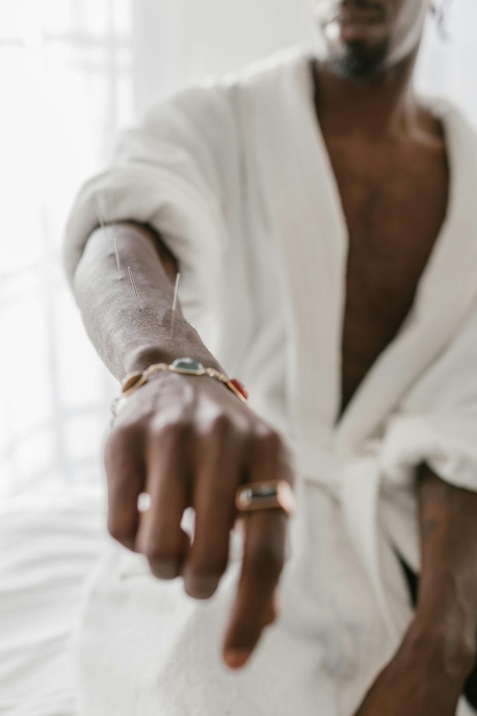 man holding out his arm showing acupuncture needles in his arm