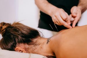 a woman laying face down receiving acupuncture treatment