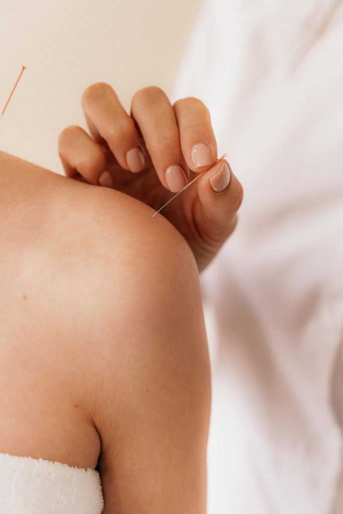 a woman getting an acupuncture needle in her shoulder - the power of a holistic team