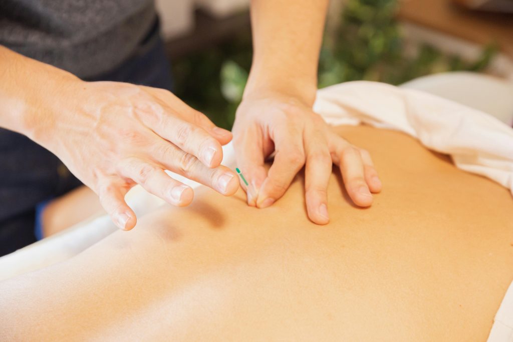 Acupuncturist placing a needle in a patient's back to support iodine and fertility treatment naturally