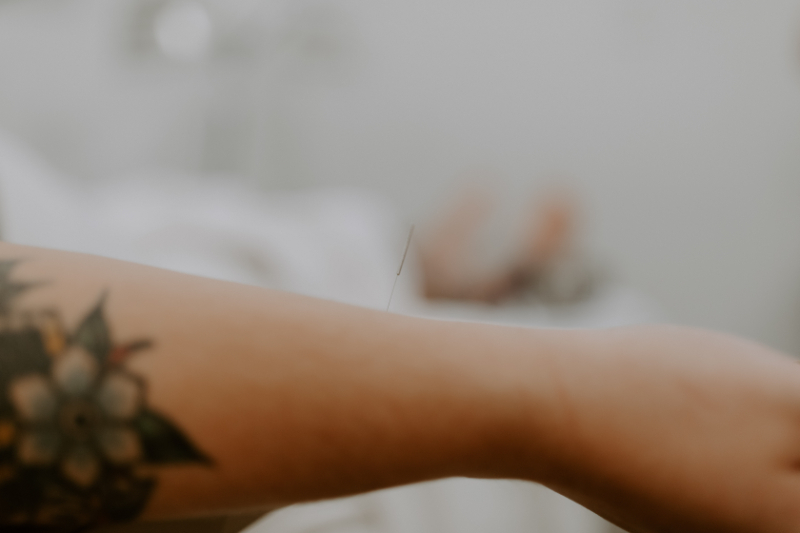 Close-up of acupuncture needle placed in arm during treatment for recurrent pregnancy loss support.
