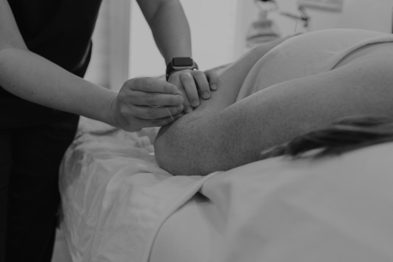 Acupuncture treatment for a patient receiving care for recurrent pregnancy loss at a wellness clinic.