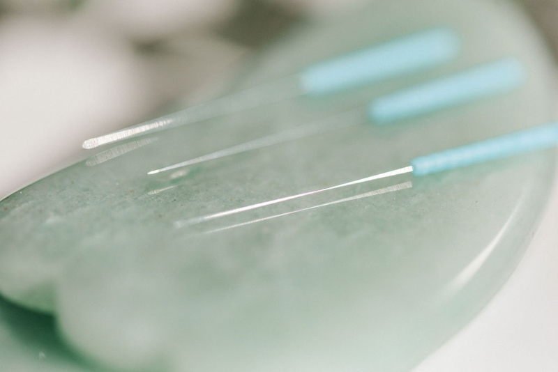 Close-up of acupuncture needles used in acupuncture for endometriosis treatment in a clinical setting