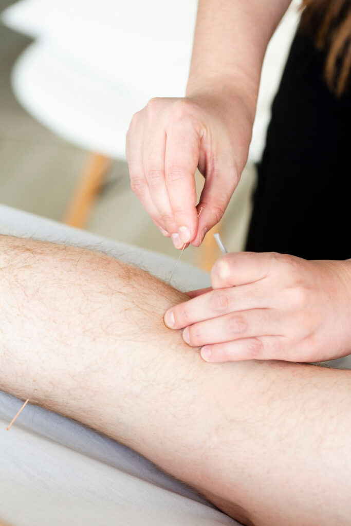 Close-up of acupuncture needles placed in leg during Men’s Health Month to support circulation and pain relief