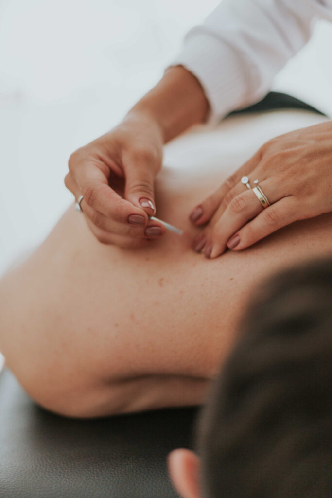 Acupuncture needles placed during treatment to support a nervous system reset and relaxation.