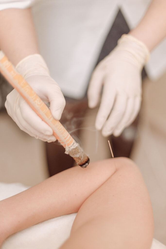 Acupuncture treatment supporting women with low ovarian reserve through gentle care and improved circulation.