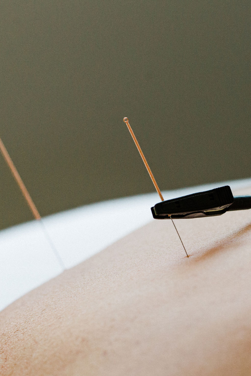 Acupuncture needle with gentle stimulation during treatment to support PCOS and fertility and healthy ovulation.