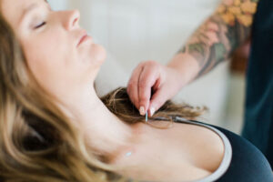 pregnant woman getting acupuncture for morning sickness