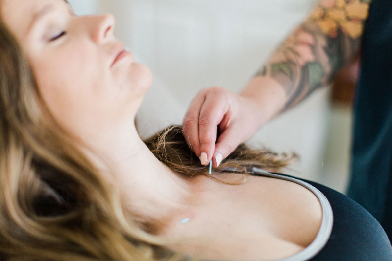 pregnant woman getting acupuncture for morning sickness
